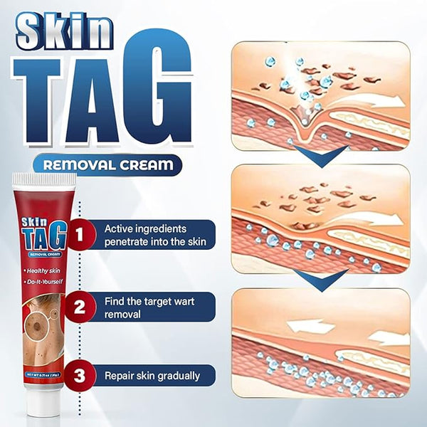 Skin Tag Remover Cream ( BUY 1 GET 1 FREE )