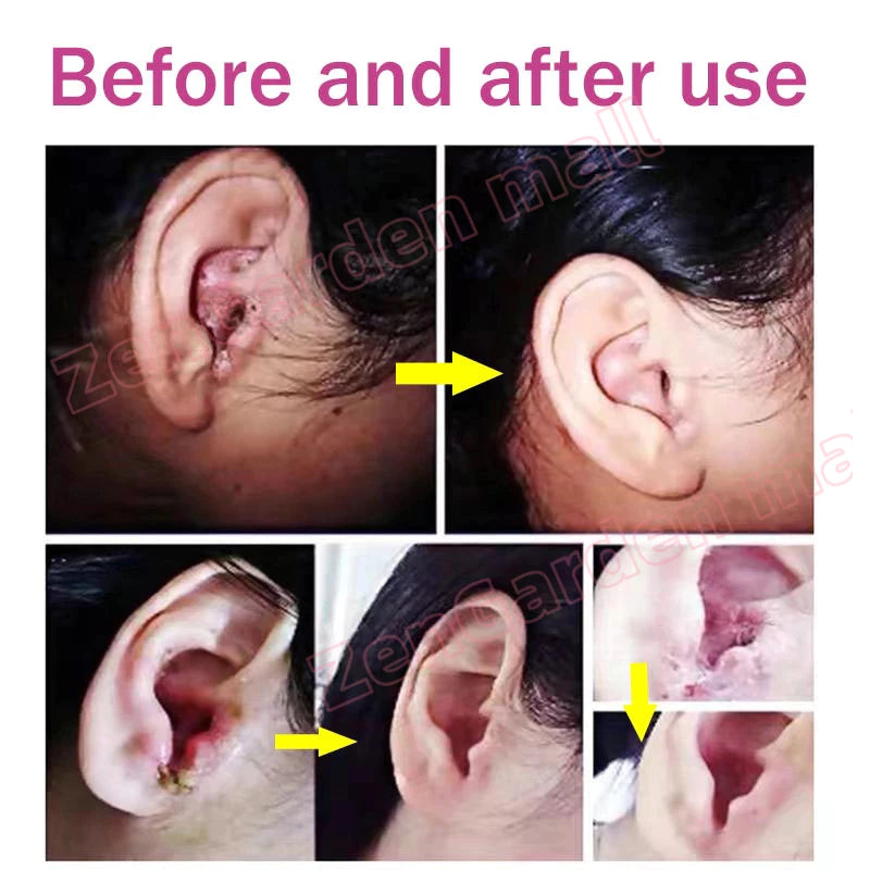 HBESTY Tinnitus Spray Multi-Symptom Relief ( BUY 1 GET 1 FREE )