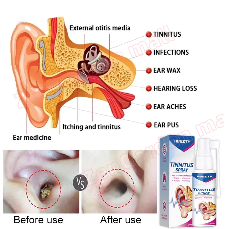 HBESTY Tinnitus Spray Multi-Symptom Relief ( BUY 1 GET 1 FREE )
