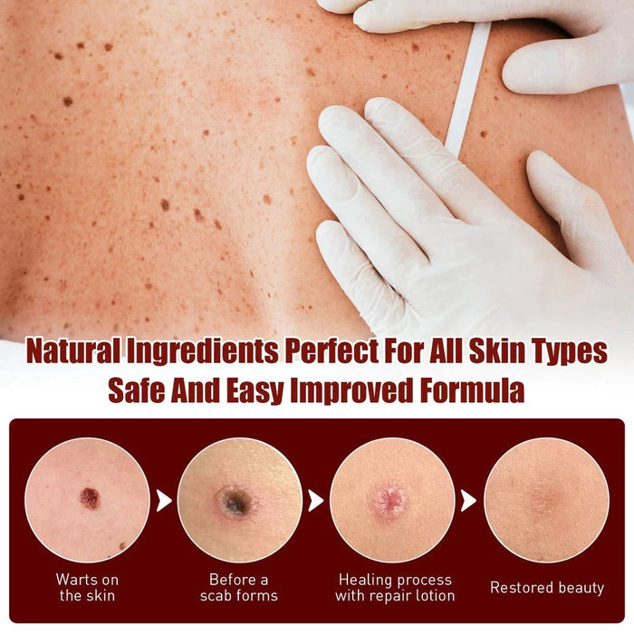 Skin Tag Remover Cream ( BUY 1 GET 1 FREE )